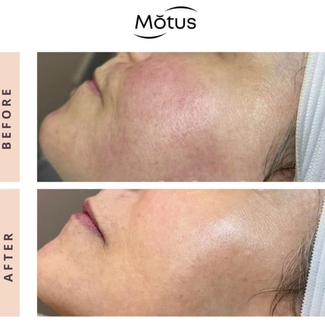 Moveo VL Face/Body Redness- 3 Pkg. at Monogram Med Spa in Harrisonburg, VA