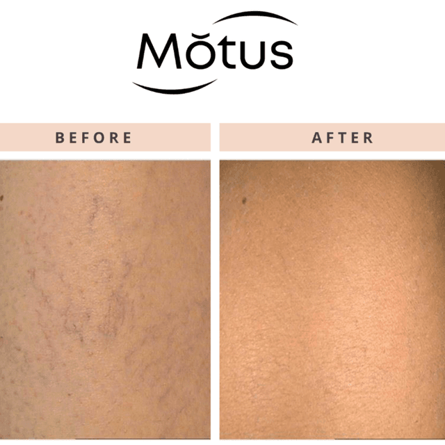 Moveo VL- Veins/Vasc- 3 Sessions at Monogram Med Spa in Harrisonburg, VA