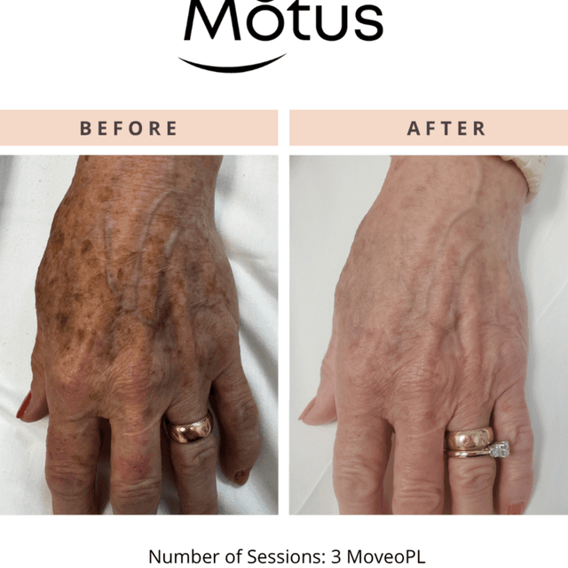 Moveo PL- LARGE 3 session package at Monogram Med Spa in Harrisonburg, VA