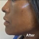 Microneedling: FACE- 6 Session Pkg.