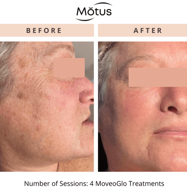 Moveo Glo ARMS– 3 Sessions at Monogram Med Spa in Harrisonburg, VA