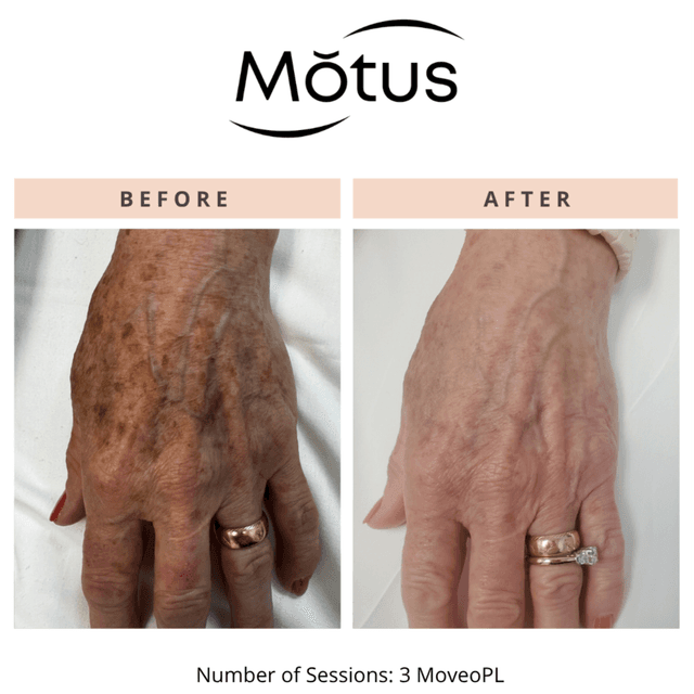 Moveo PL- SMALL- 3 Session Package at Monogram Med Spa in Harrisonburg, VA