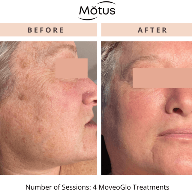 Moveo Glo – Face/Chest | 3 Sessions at Monogram Med Spa in Harrisonburg, VA