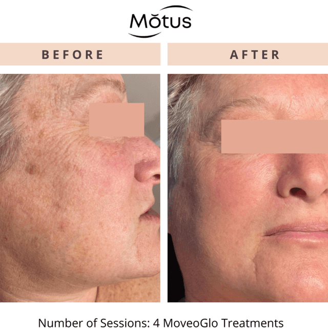 Moveo Glo FACE– 3 Sessions at Monogram Med Spa in Harrisonburg, VA