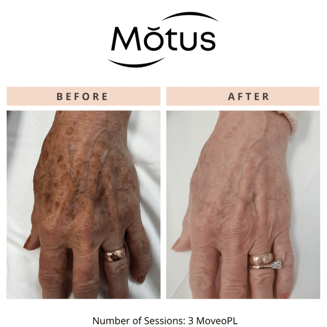 Moveo PL- MEDIUM 3 Session package at Monogram Med Spa in Harrisonburg, VA