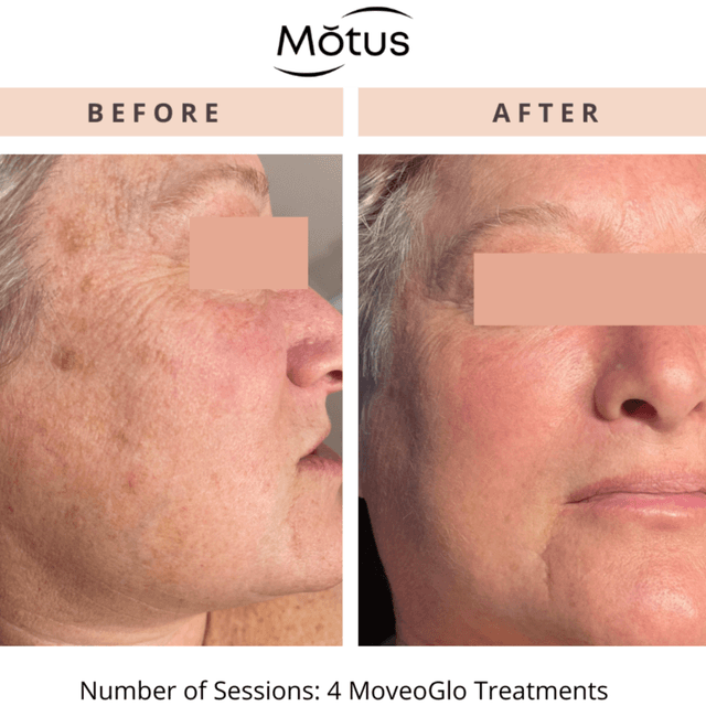 Moveo Glo CHEST- Package of 3 at Monogram Med Spa in Harrisonburg, VA