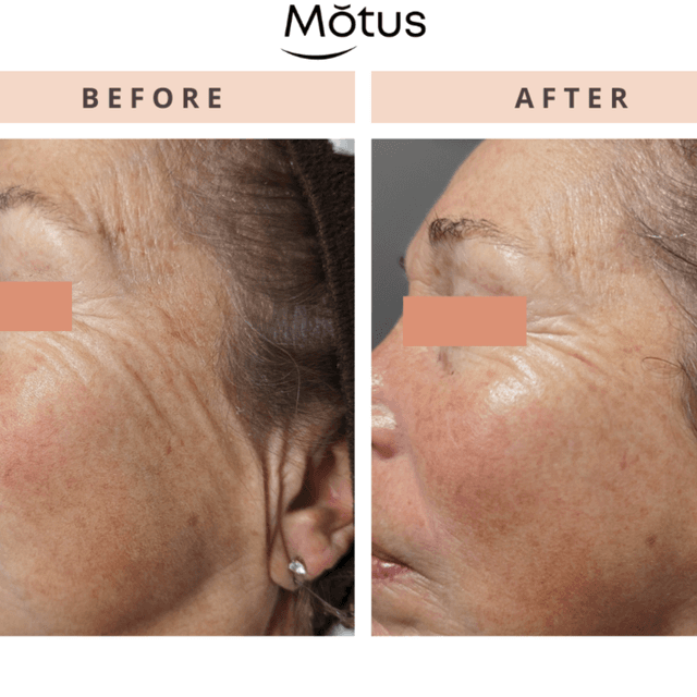 Moveo SR Revitalization–3 Sessions at Monogram Med Spa in Harrisonburg, VA